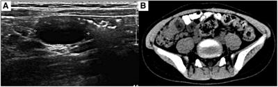 Case report: Ileocecal preservation for multiple small intestinal duplications